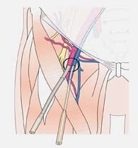 Obr. 1 – Periferní zavedení arteriální a venózní kanyly