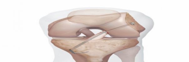 Nová metoda léčby kolena pomocí vnitřní ortézy zkrátí návrat ke sportu na polovinu