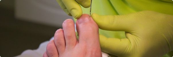 Využití odlehčení individuální ortézou typu Sarmiento u pacienta se syndromem diabetické nohy 