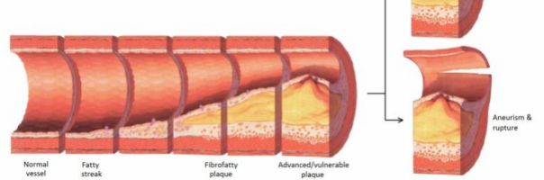 Boj s aterosklerózou:  větší síla, nebo lepší načasování? 
