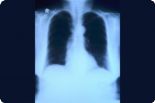Od nového roku doporučí praktici silným kuřákům bezplatný screening plic