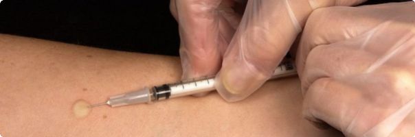 Proti žloutence chrání očkování, zájem o něj po covidu opět stoupá