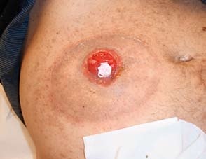 Obr. 5 – Poškozená peristomální kůže při chemoterapii