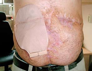 Obr. 6 – Výpustný sáček na ileostomii v komplikovaném terénu