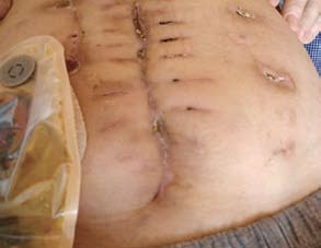 Obr. 1 – Ileostomie a komplikované hojení laparotomie
