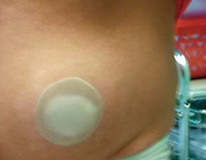 Obr. 3 – Irigující kolostomik s krytkou z hydrokoloidu