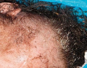 Obr. 3 – Detailní pohled na larvy ve kštici pacienta