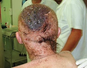 Obr. 4 – Pacient po odstranění kštice s defektem v parietookcipitální krajině