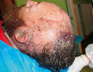 Obr. 1 – Larvy vylézající z levého zvukovodu pacienta