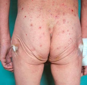 Obr. 5 – Dekubity na trnech kostí kyčelních, aplikován Hydrocoll, ošetření projevů na kůži 20% sírovou mastí