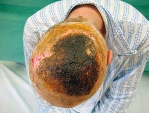 Obr. 6 – Nekrotický defekt v parietookcipitální krajině