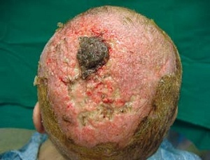 Obr. 10 – Defekt po chirurgickém débridementu, středem zůstává ulpívající nekróza