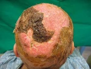 Obr. 7 – Snímek po provedeném chirurgickém débridementu