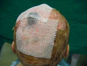 Obr. 11 – Aplikace neadherentního krytí Grassolind