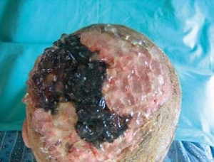 Obr. 8 – Aplikován hydrogel s alginátem Nu-Gel