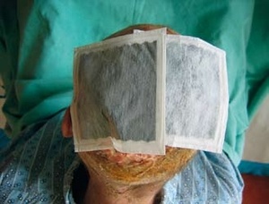 Obr. 9 – Aplikace krytí s aktivním uhlím a stříbrem – Actisorb Plus