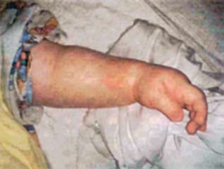 Postižená končetina