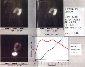 Transplantované dětské ledviny