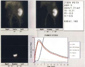 Normální nález – 2 dny po transplantaci ledviny
