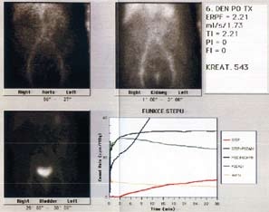Aperfúze graftu – 6. den po transplantaci – trombóza renální arterie